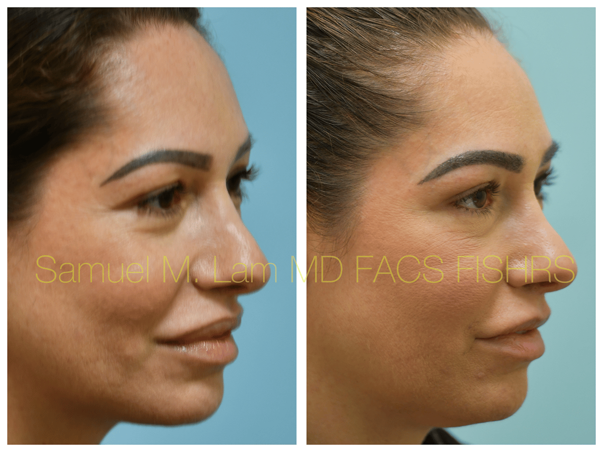 Lip Reduction Before and After Photo by Dr. Lam in Plano TX
