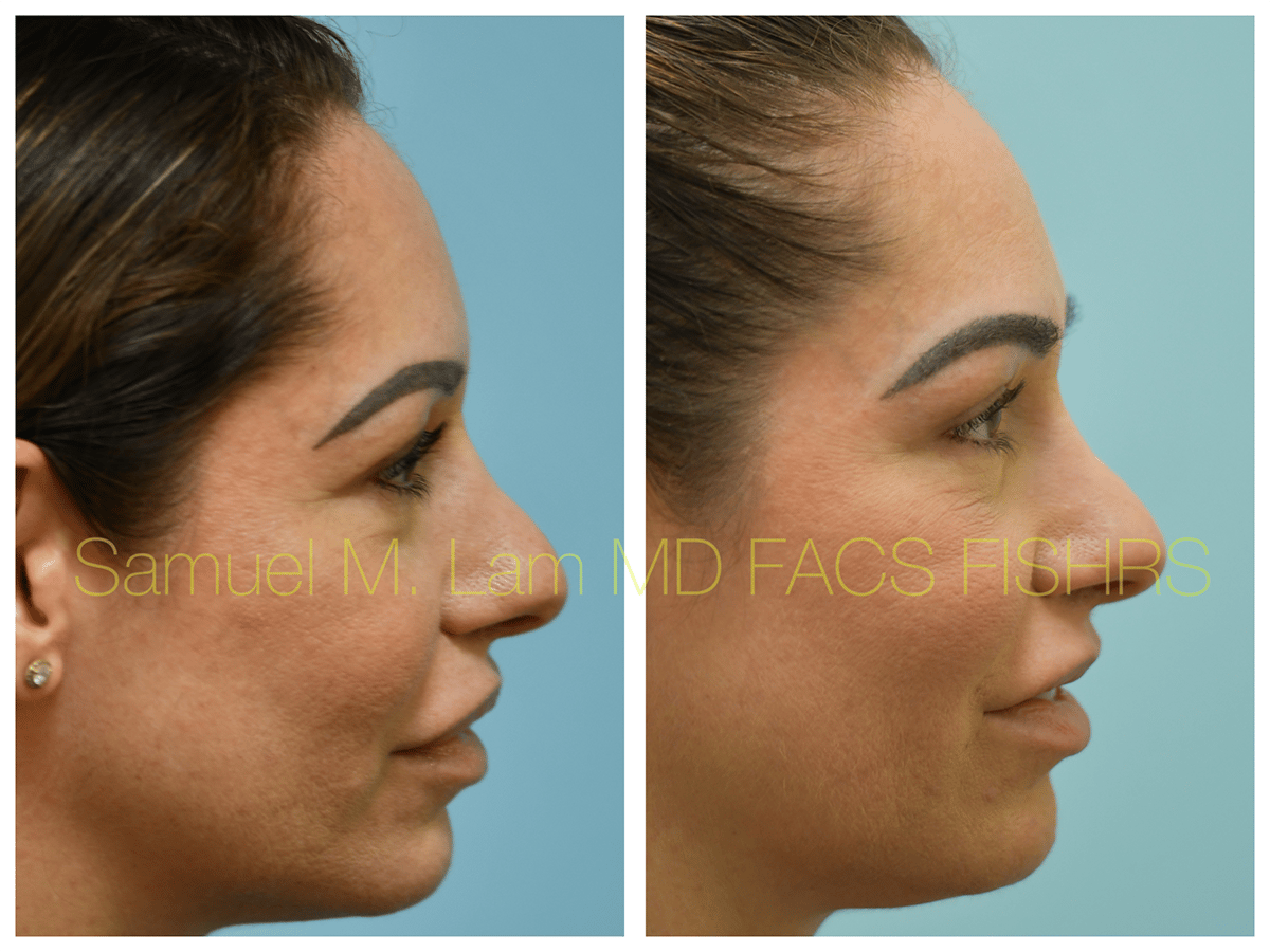 Lip Reduction Before and After Photo by Dr. Lam in Plano TX