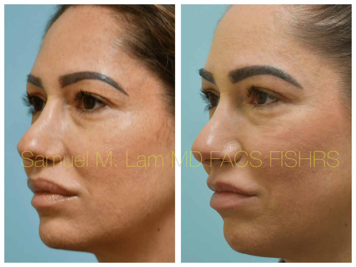 Lip Reduction Before and After Photo by Dr. Lam in Plano TX