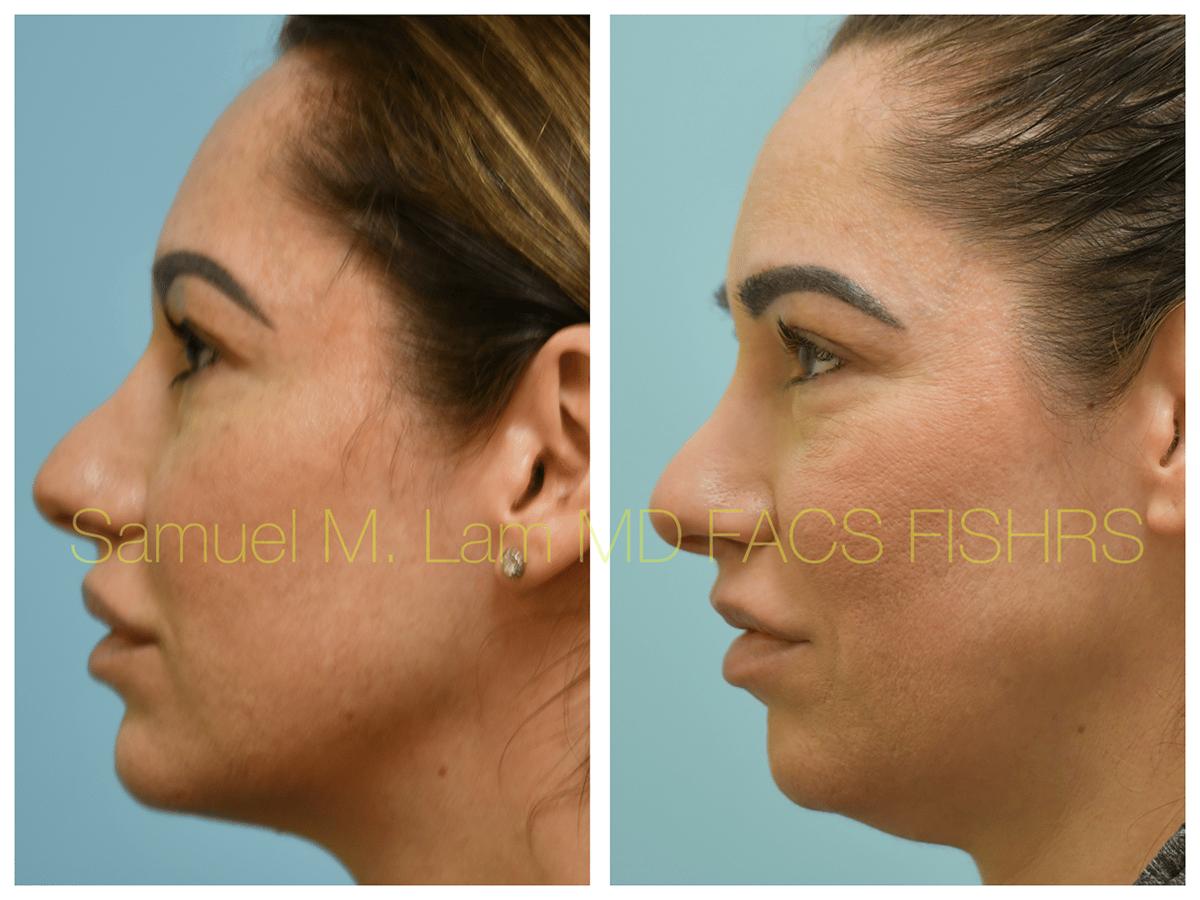 Lip Reduction Before and After Photo by Dr. Lam in Plano TX