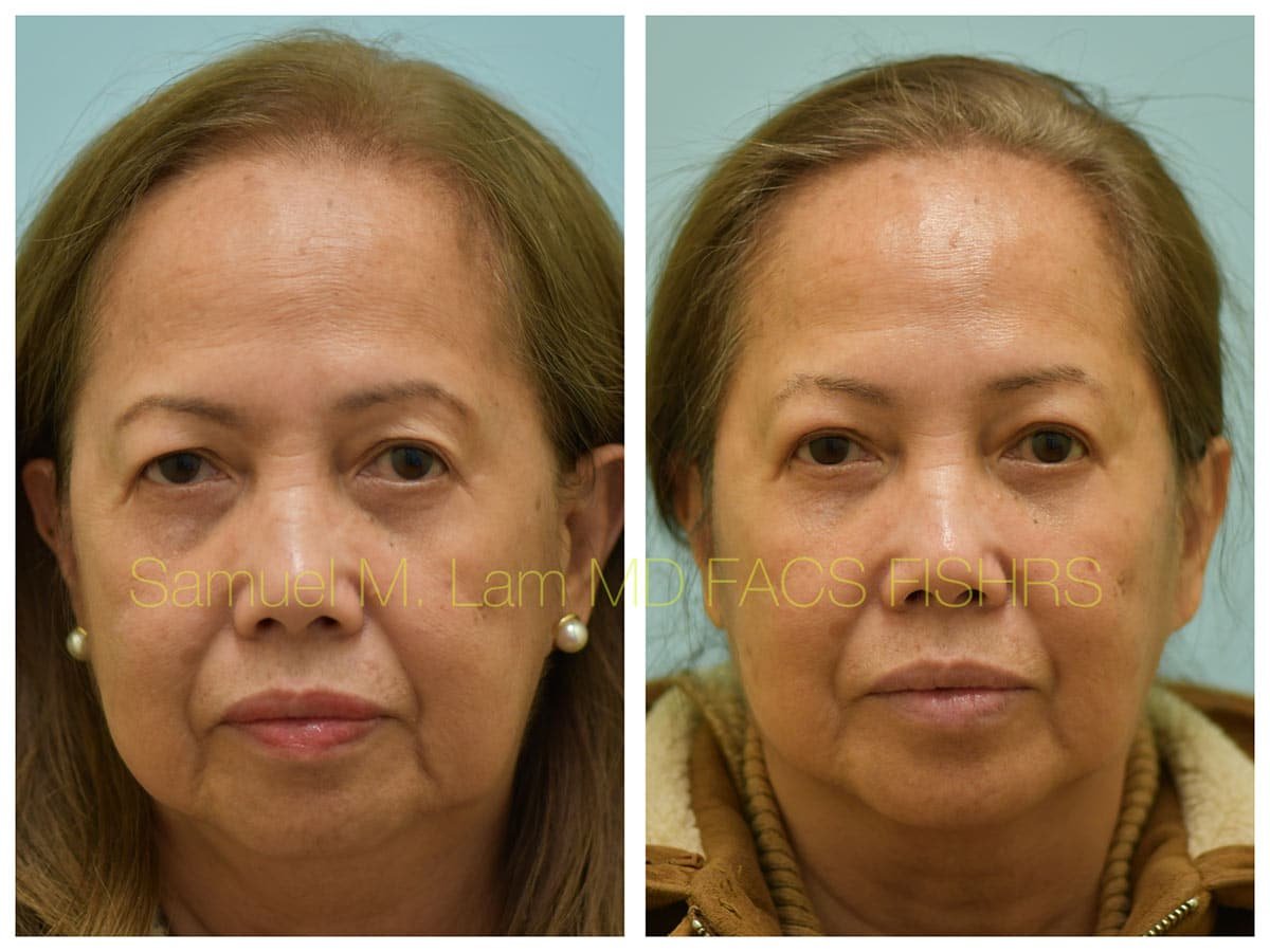 Blepharoplasty and Fat Grafting Before and After Photo by Dr. Lam in Plano TX Blepharoplasty and Fat Grafting Before and After Photo by Dr. Lam in Plano TX