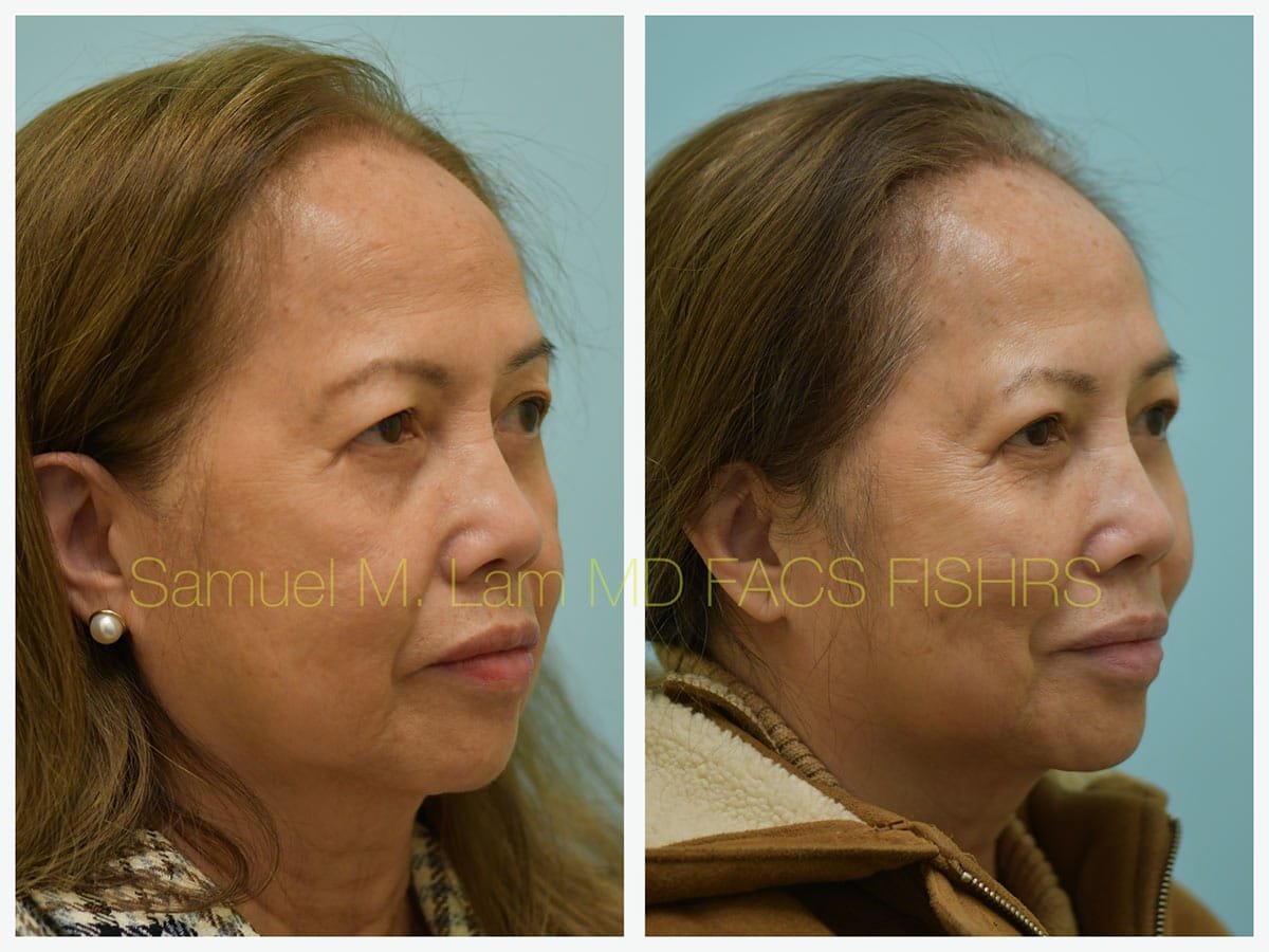 Blepharoplasty and Fat Grafting Before and After Photo by Dr. Lam in Plano TX Blepharoplasty and Fat Grafting Before and After Photo by Dr. Lam in Plano TX