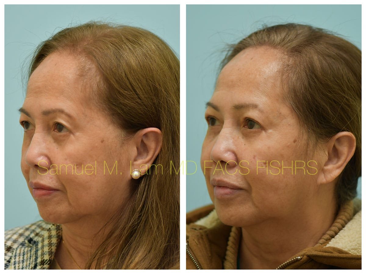 Blepharoplasty and Fat Grafting Before and After Photo by Dr. Lam in Plano TX Blepharoplasty and Fat Grafting Before and After Photo by Dr. Lam in Plano TX