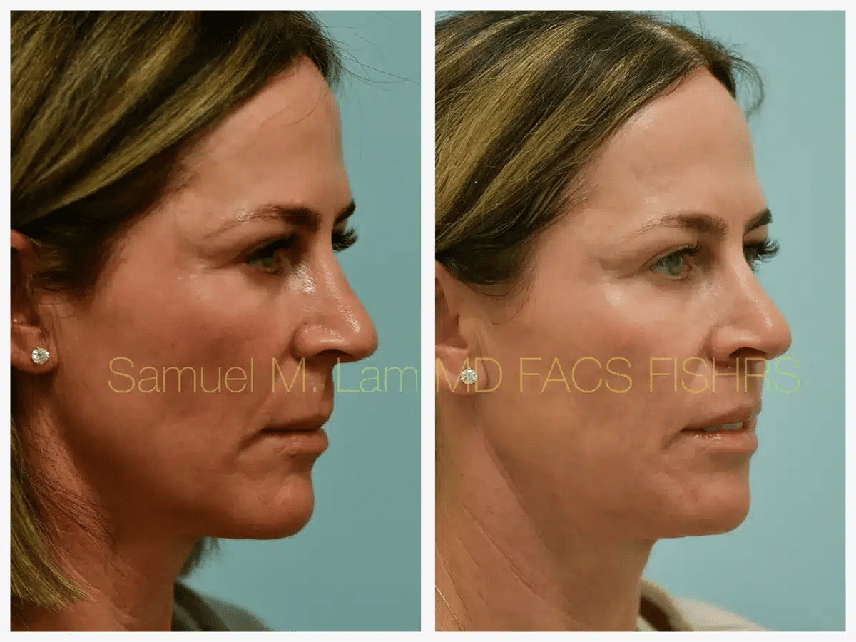 Lip Lift Before and After Photo by Dr. Lam in Plano TX