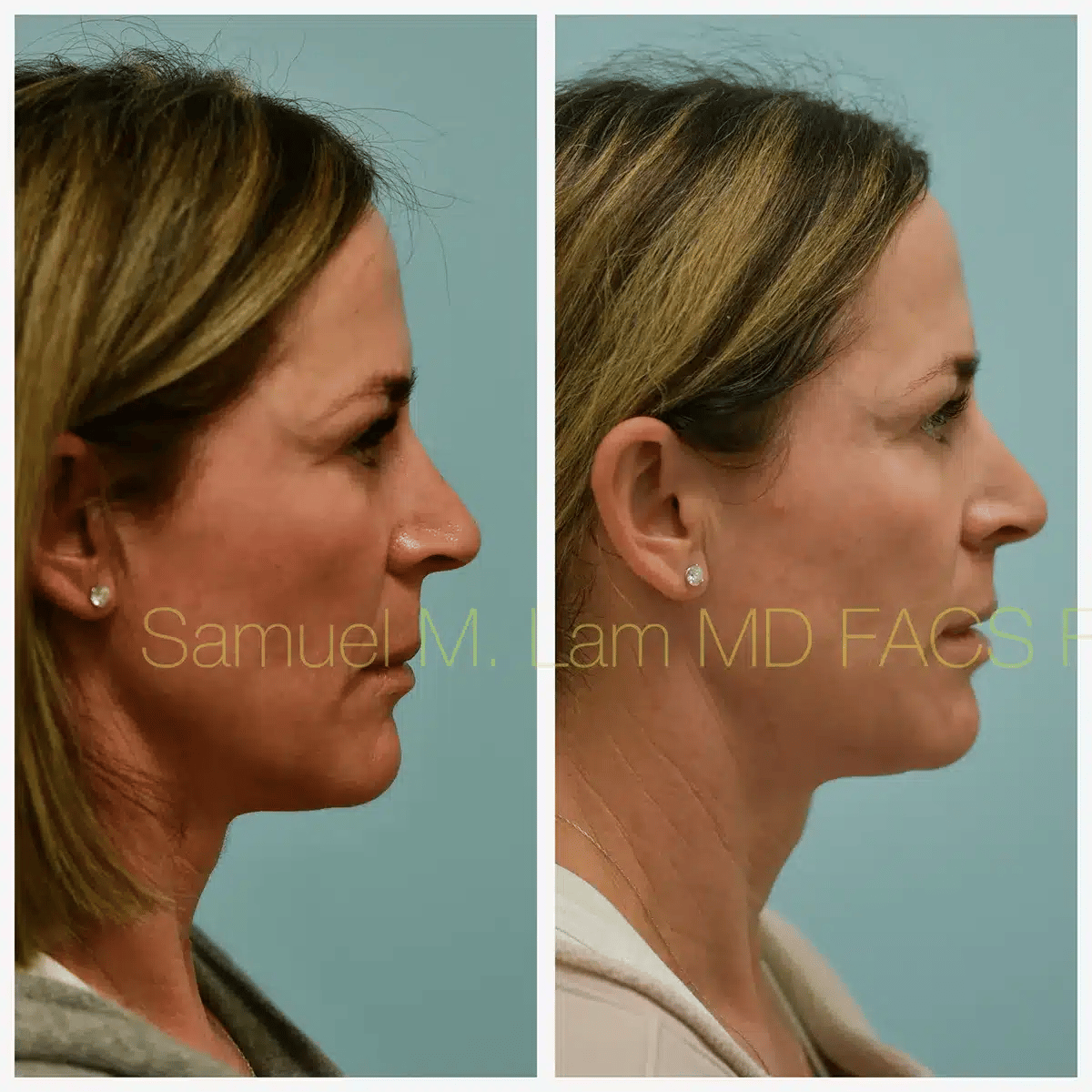 Lip Lift Before and After Photo by Dr. Lam in Plano TX