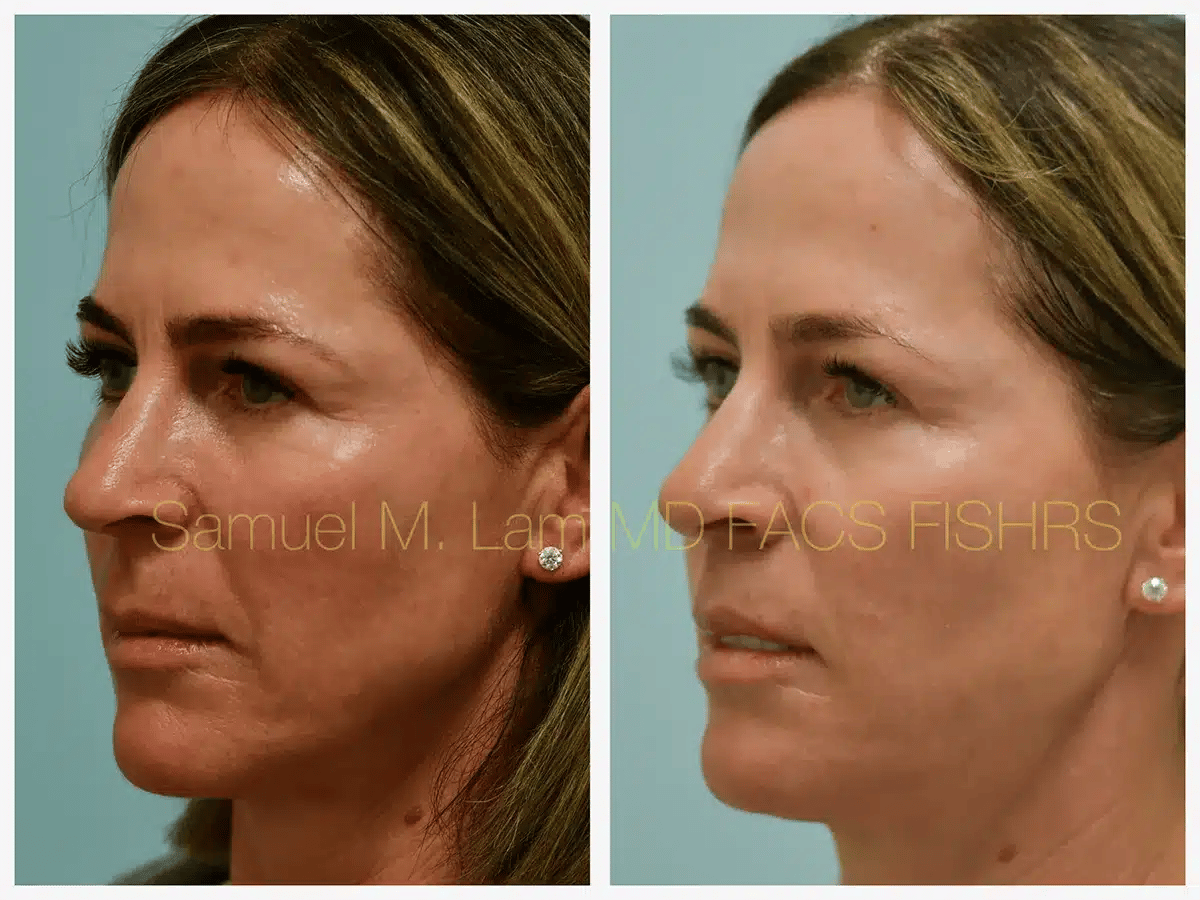Lip Lift Before and After Photo by Dr. Lam in Plano TX