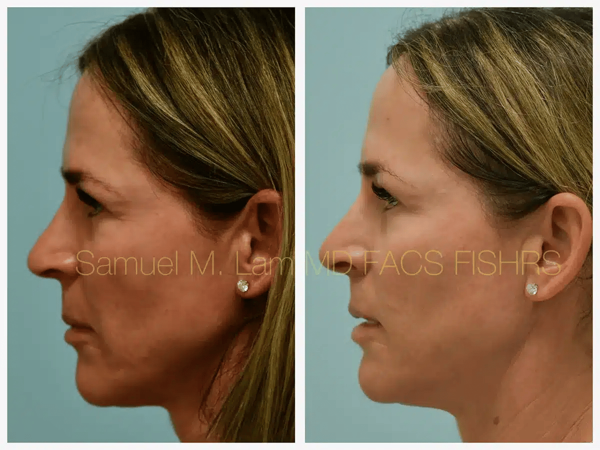 Lip Lift Before and After Photo by Dr. Lam in Plano TX