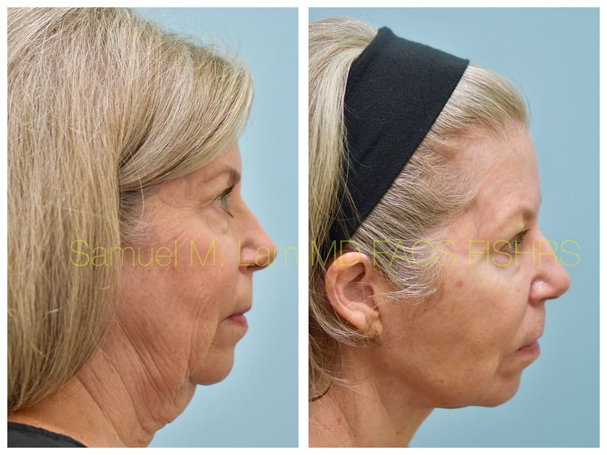 Facelift Before and After Photo by Dr. Lam in Plano TX