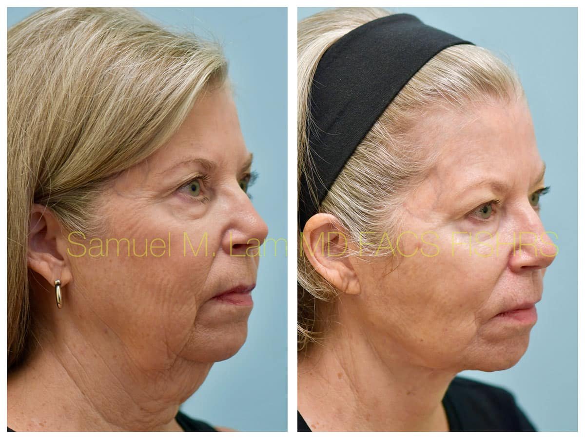 Facelift Before and After Photo by Dr. Lam in Plano TX