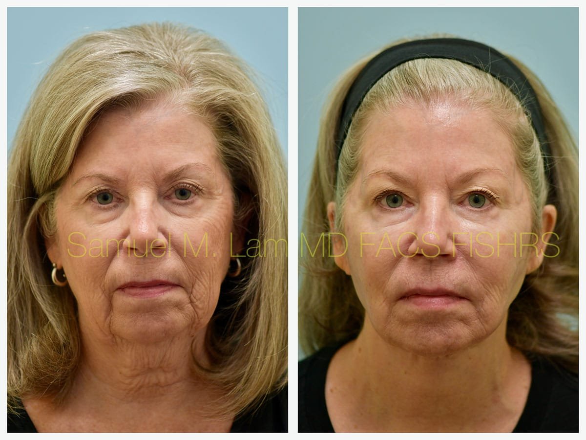 Facelift Before and After Photo by Dr. Lam in Plano TX