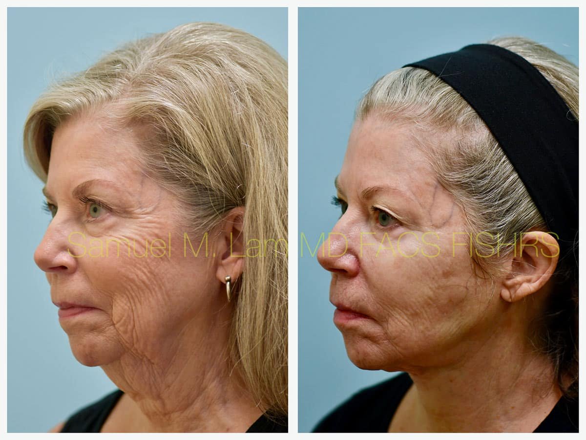 Facelift Before and After Photo by Dr. Lam in Plano TX