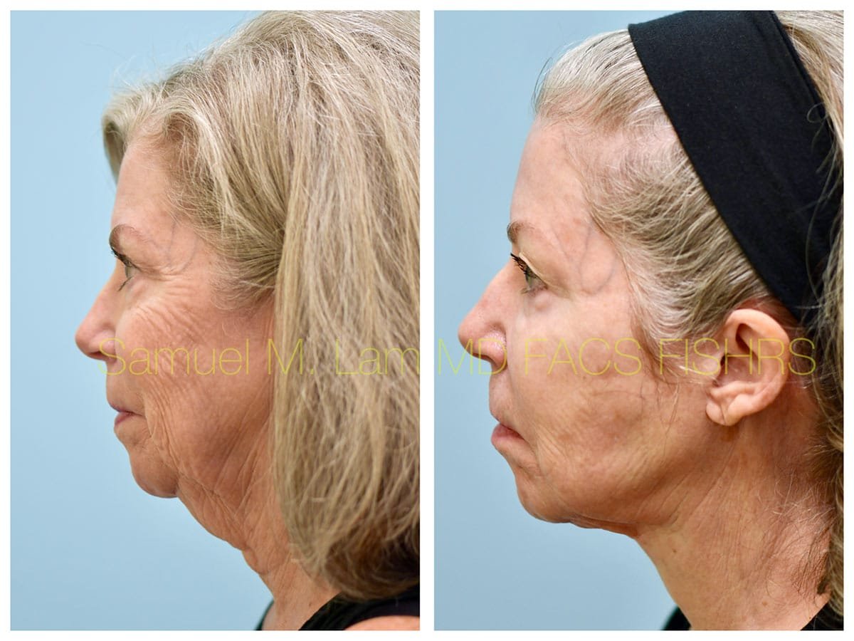 Facelift Before and After Photo by Dr. Lam in Plano TX
