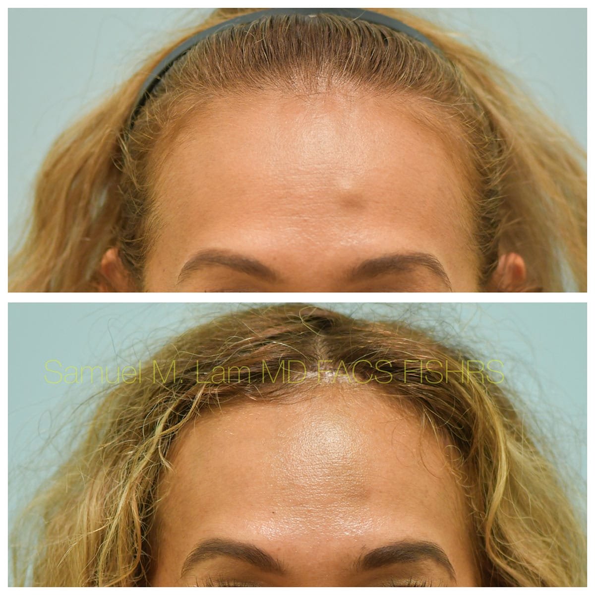 Osteoma Remval Before and After Photo by Dr. Lam in Plano TX Osteoma Remval Before and After Photo by Dr. Lam in Plano TX