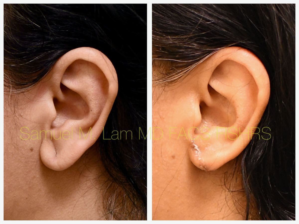Torn Earlobe Repair Before and After Photo by Dr. Lam in Plano TX Torn Earlobe Repair Before and After Photo by Dr. Lam in Plano TX