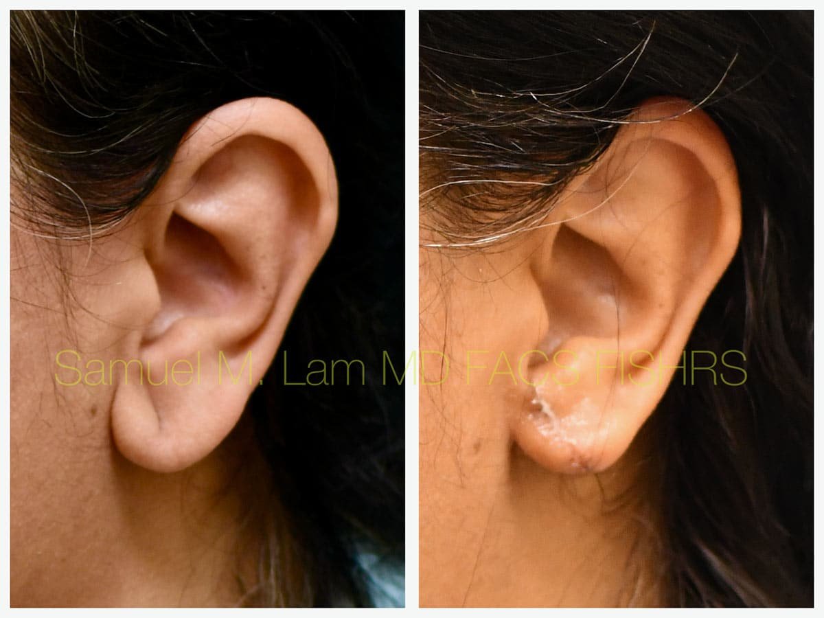 Torn Earlobe Repair Before and After Photo by Dr. Lam in Plano TX Torn Earlobe Repair Before and After Photo by Dr. Lam in Plano TX