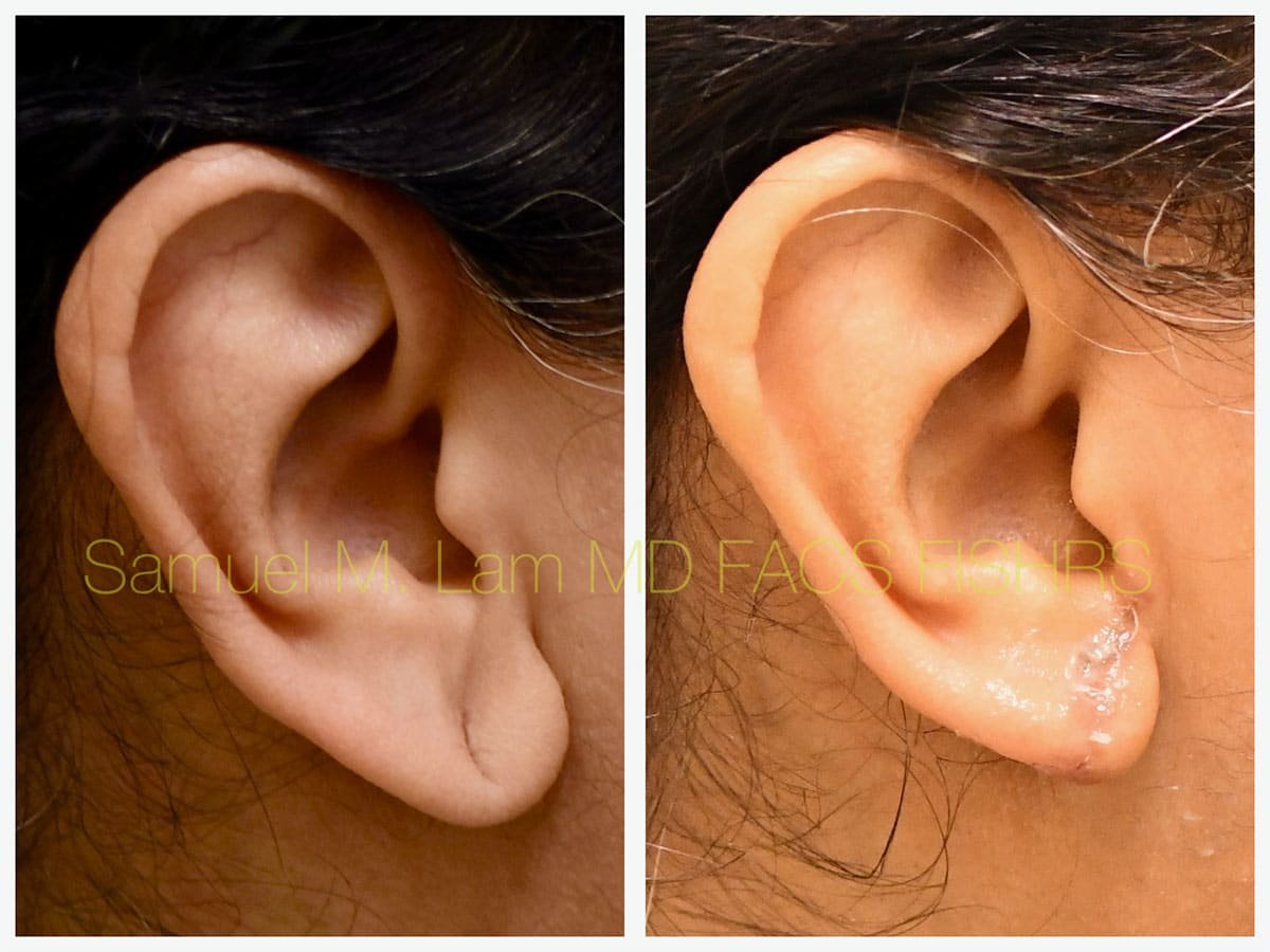 Torn Earlobe Repair Before and After Photo by Dr. Lam in Plano TX Torn Earlobe Repair Before and After Photo by Dr. Lam in Plano TX