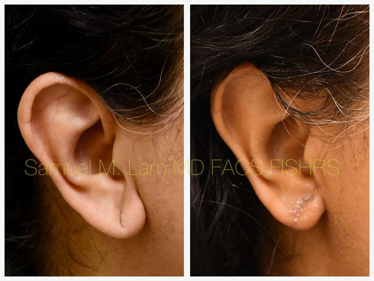 Torn Earlobe Repair Before and After Photo by Dr. Lam in Plano TX Torn Earlobe Repair Before and After Photo by Dr. Lam in Plano TX