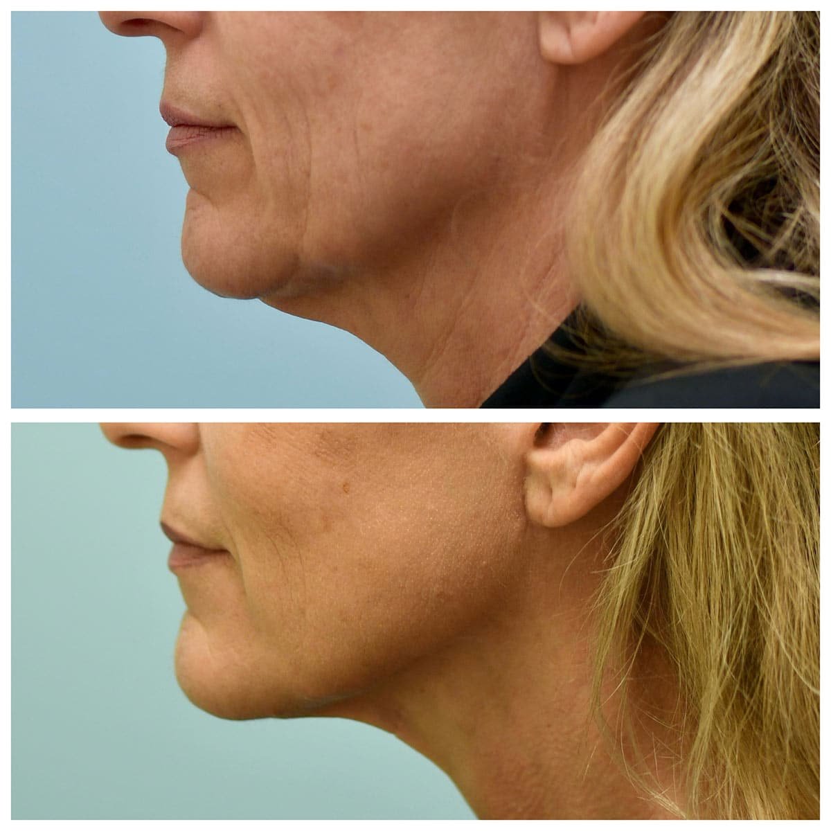 Face:Neck Lift Before and After Photo by Dr. Lam in Plano, TX