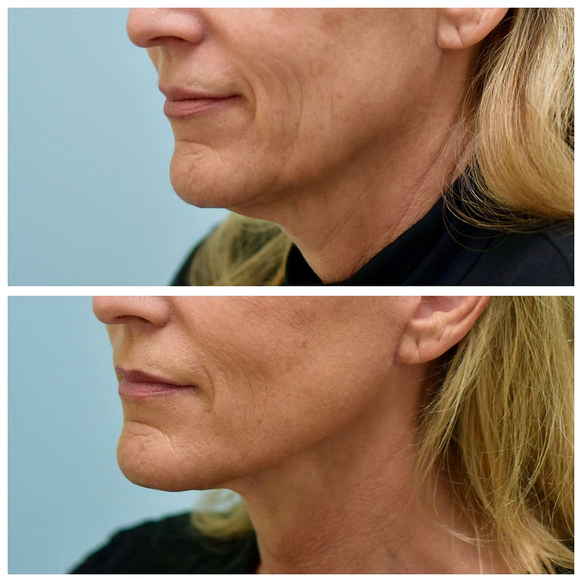 Face:Neck Lift Before and After Photo by Dr. Lam in Plano, TX