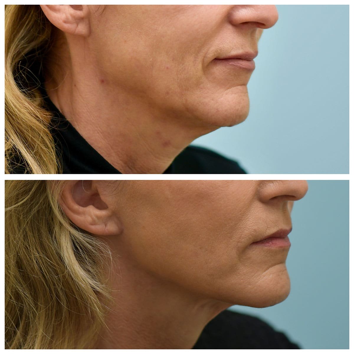 Face:Neck Lift Before and After Photo by Dr. Lam in Plano, TX