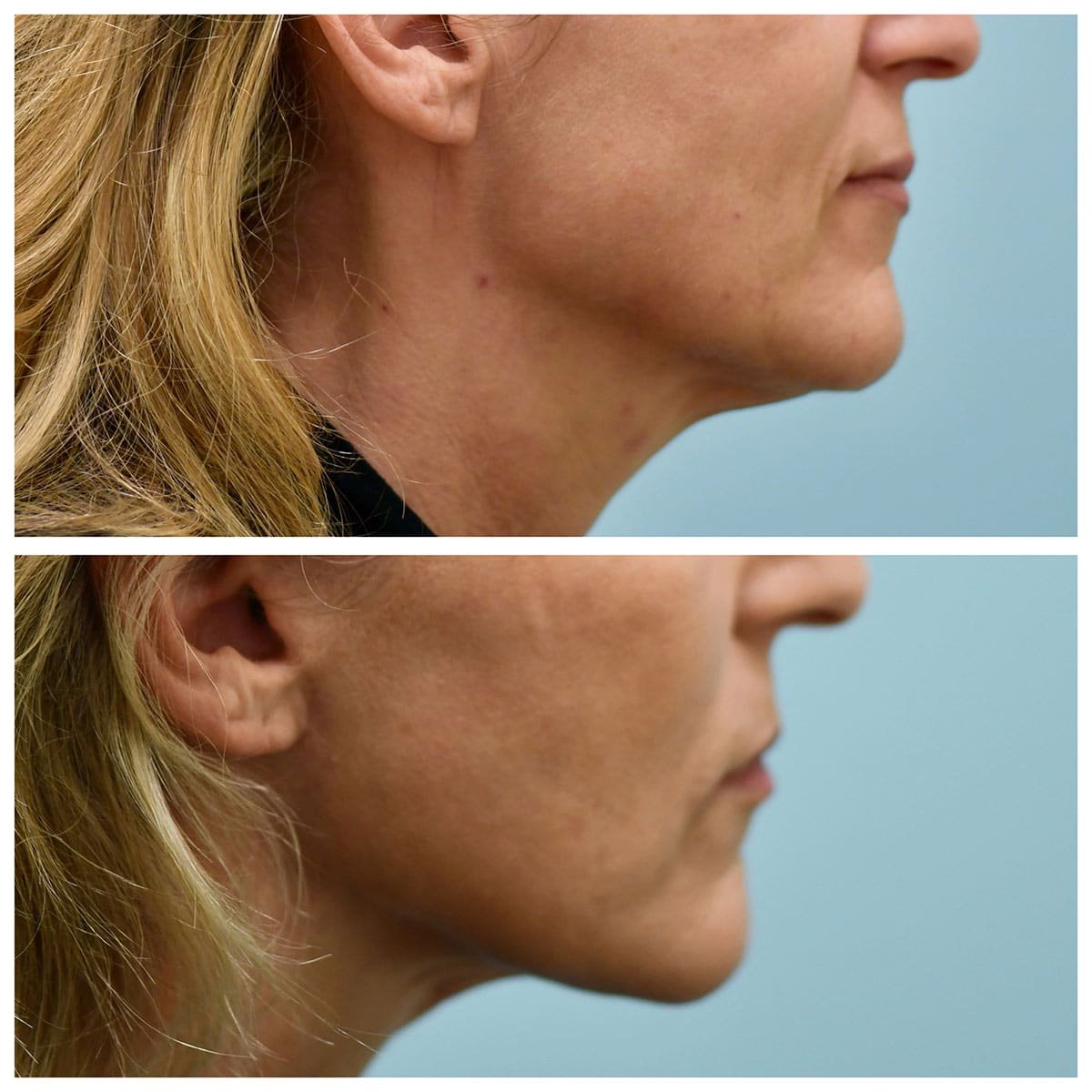 Face:Neck Lift Before and After Photo by Dr. Lam in Plano, TX