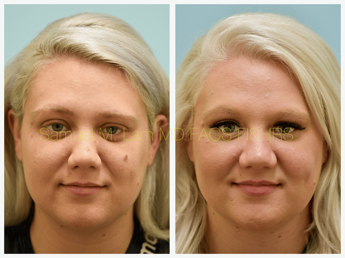 Mole Removal Before and After Photo by Dr. Lam in Plano TX