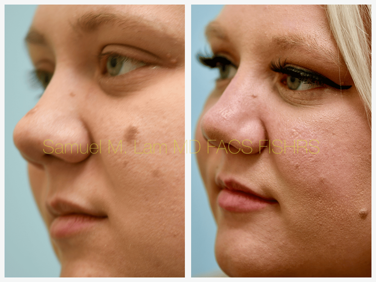 Mole Removal Before and After Photo by Dr. Lam in Plano TX