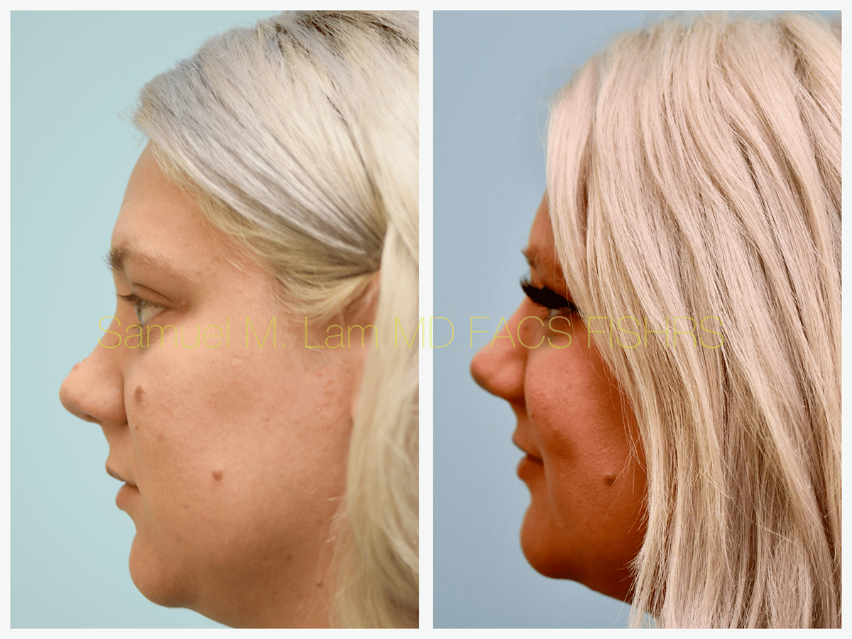 Mole Removal Before and After Photo by Dr. Lam in Plano TX