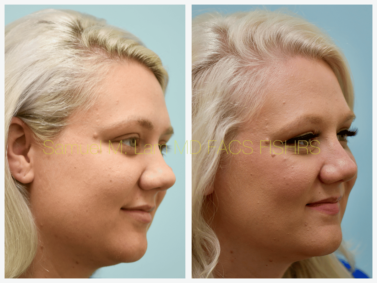 Mole Removal Before and After Photo by Dr. Lam in Plano TX