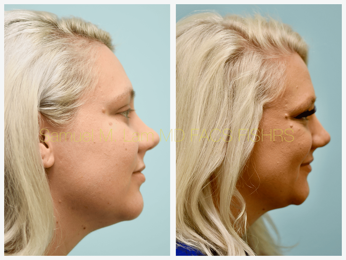 Mole Removal Before and After Photo by Dr. Lam in Plano TX