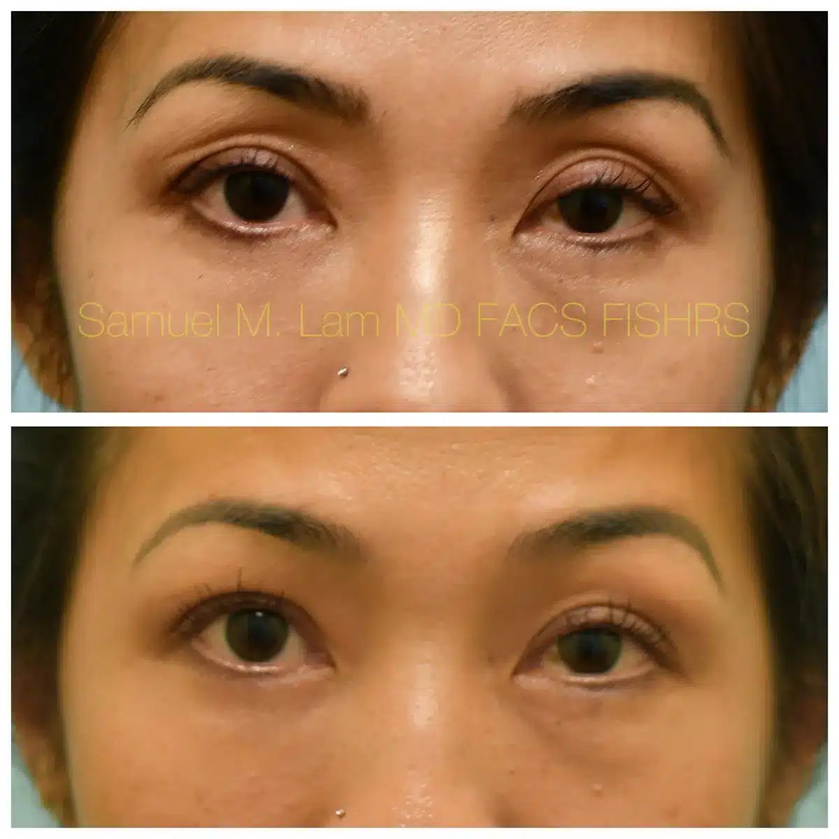 Fat grafting and bilateral internal ptosis repair Before and After Photo by Dr. Lam in Plano TX Fat grafting and bilateral internal ptosis repair Before and After Photo by Dr. Lam in Plano TX