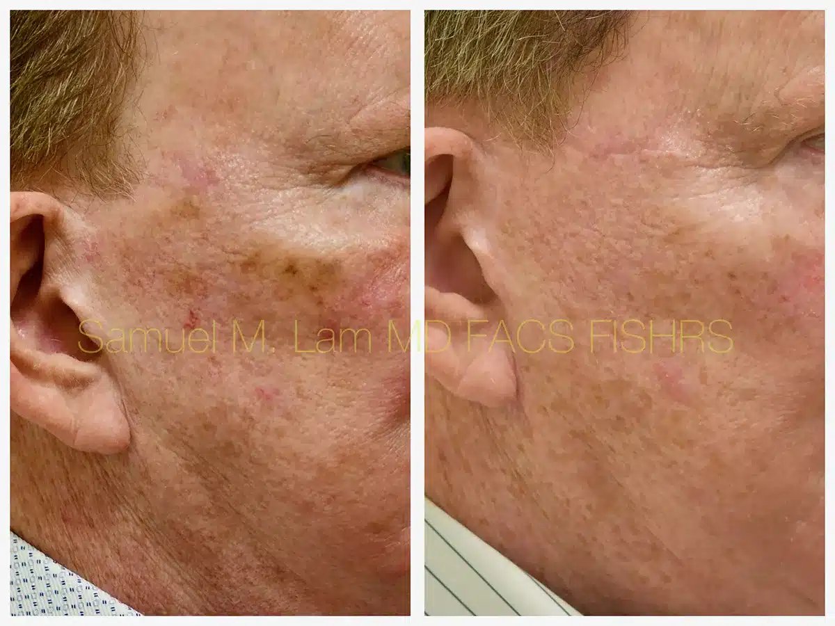 MesoTox Before and After Photo by Dr. Lam in Plano TX MesoTox Before and After Photo by Dr. Lam in Plano TX