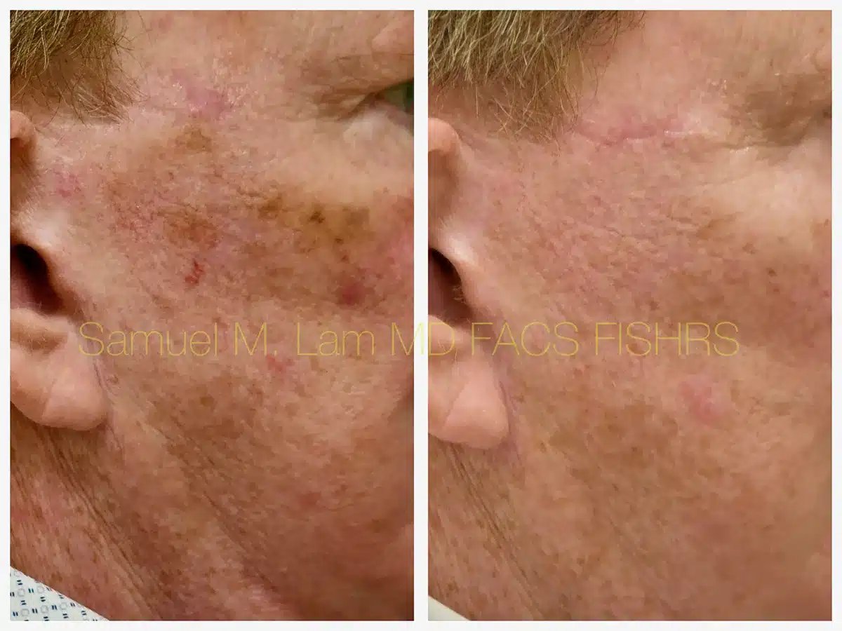 MesoTox Before and After Photo by Dr. Lam in Plano TX MesoTox Before and After Photo by Dr. Lam in Plano TX