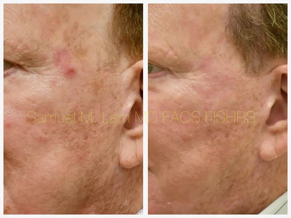 MesoTox Before and After Photo by Dr. Lam in Plano TX MesoTox Before and After Photo by Dr. Lam in Plano TX