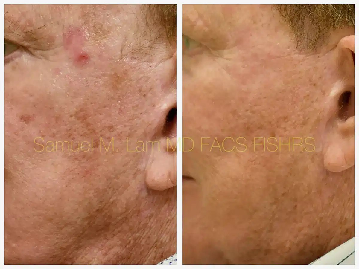 MesoTox Before and After Photo by Dr. Lam in Plano TX MesoTox Before and After Photo by Dr. Lam in Plano TX