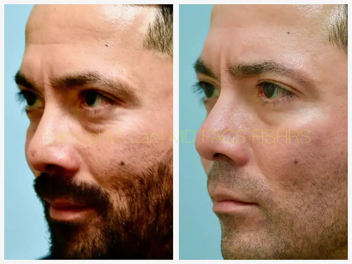 Scar Revision Before and After Photo by Dr. Lam in Plano TX
