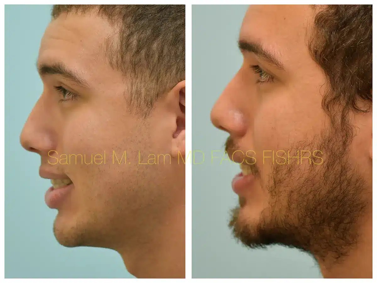 Lip Reduction Before and After Photo by Dr. Lam in Plano TX