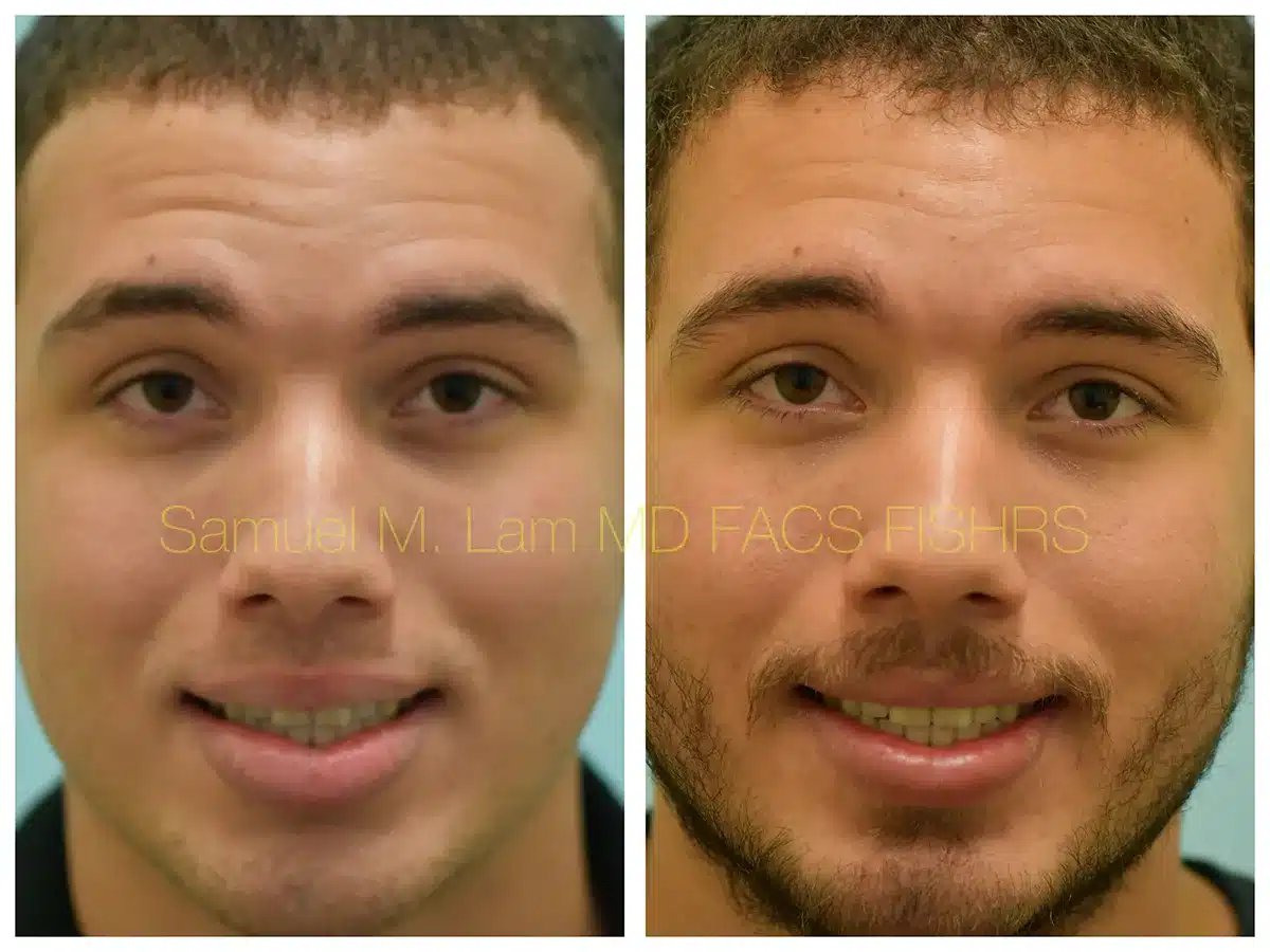 Lip Reduction Before and After Photo by Dr. Lam in Plano TX