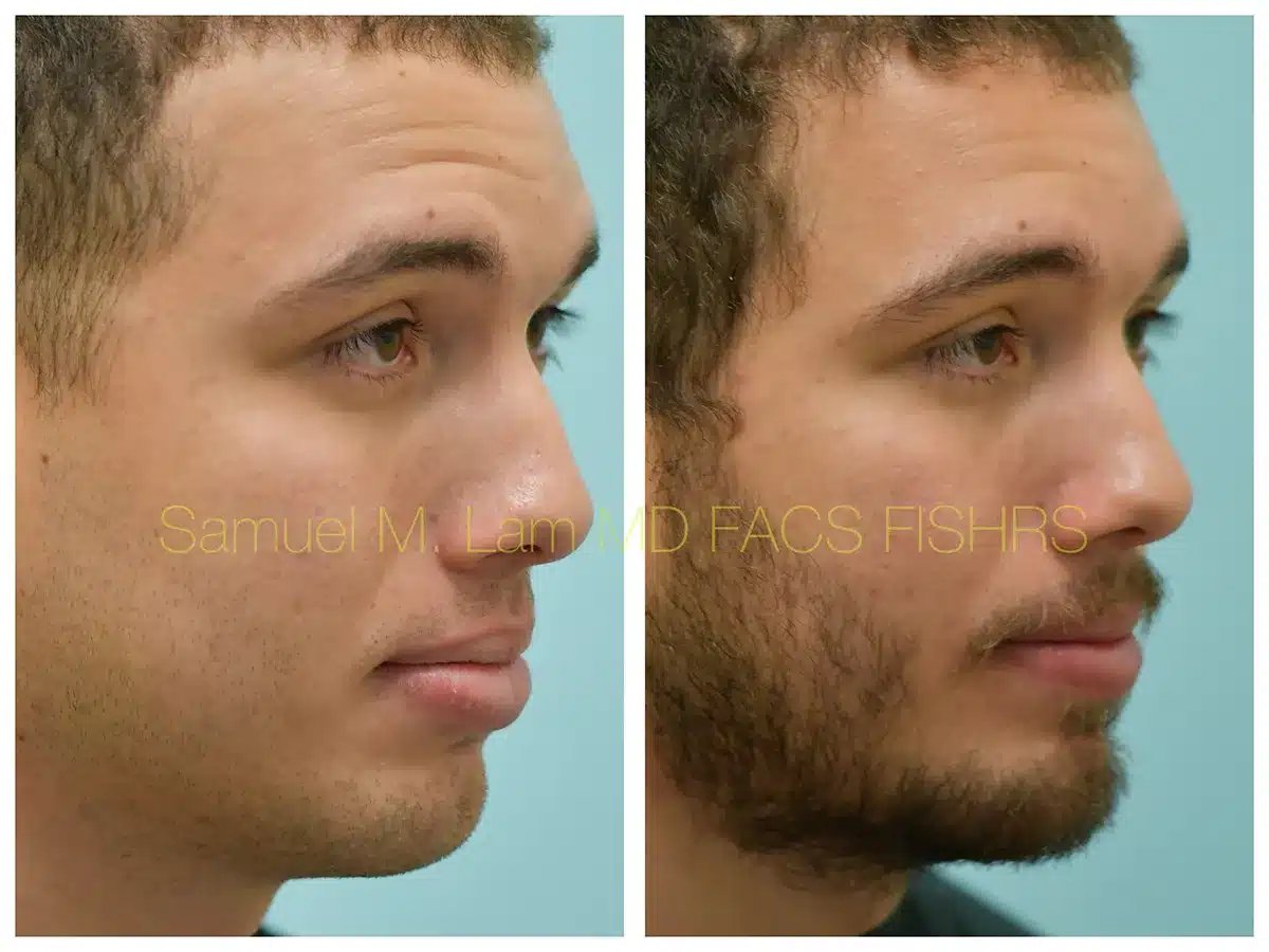 Lip Reduction Before and After Photo by Dr. Lam in Plano TX