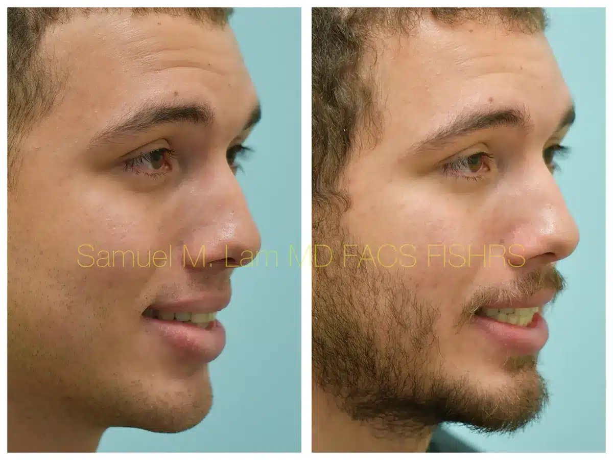 Lip Reduction Before and After Photo by Dr. Lam in Plano TX