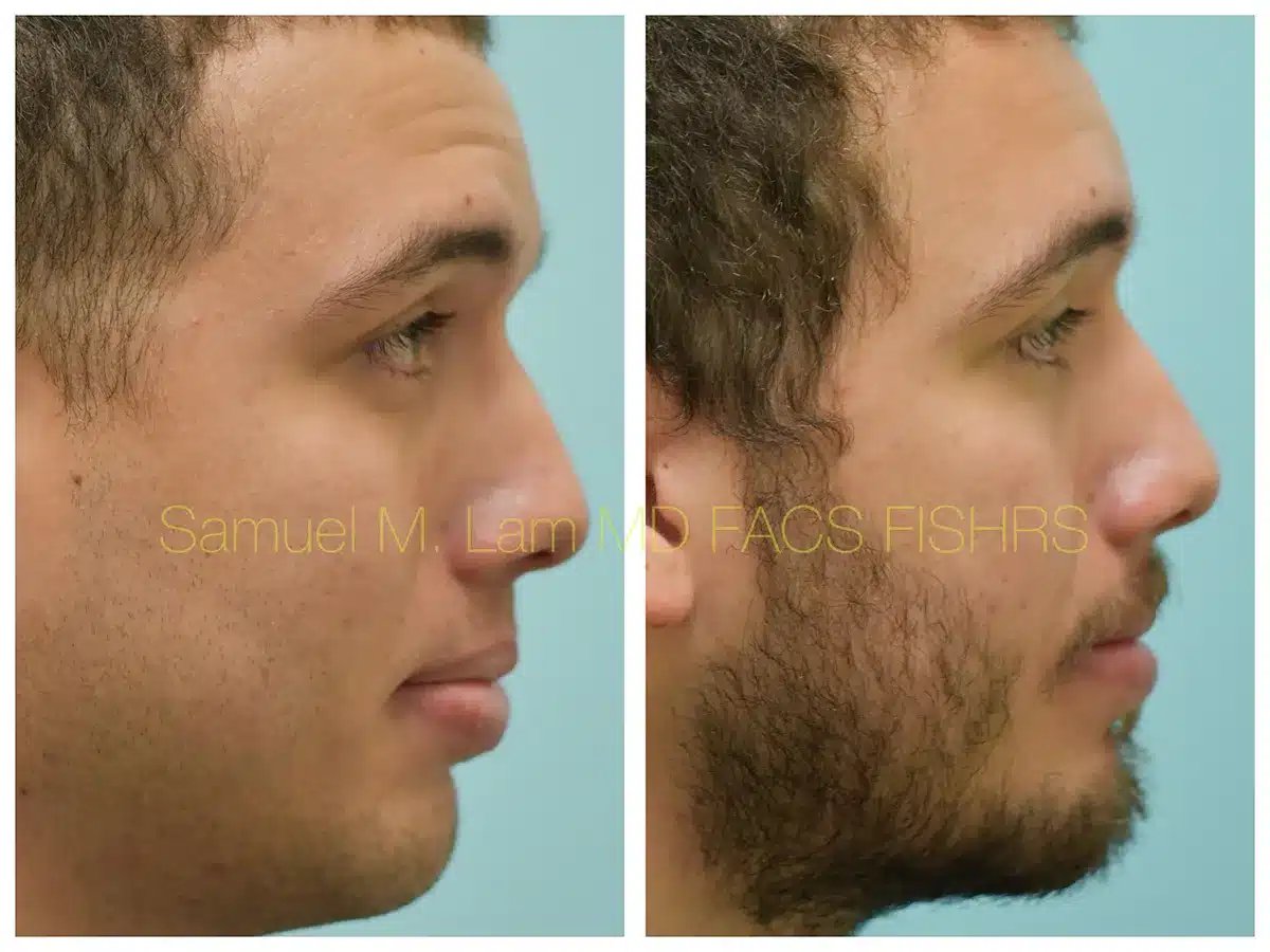 Lip Reduction Before and After Photo by Dr. Lam in Plano TX