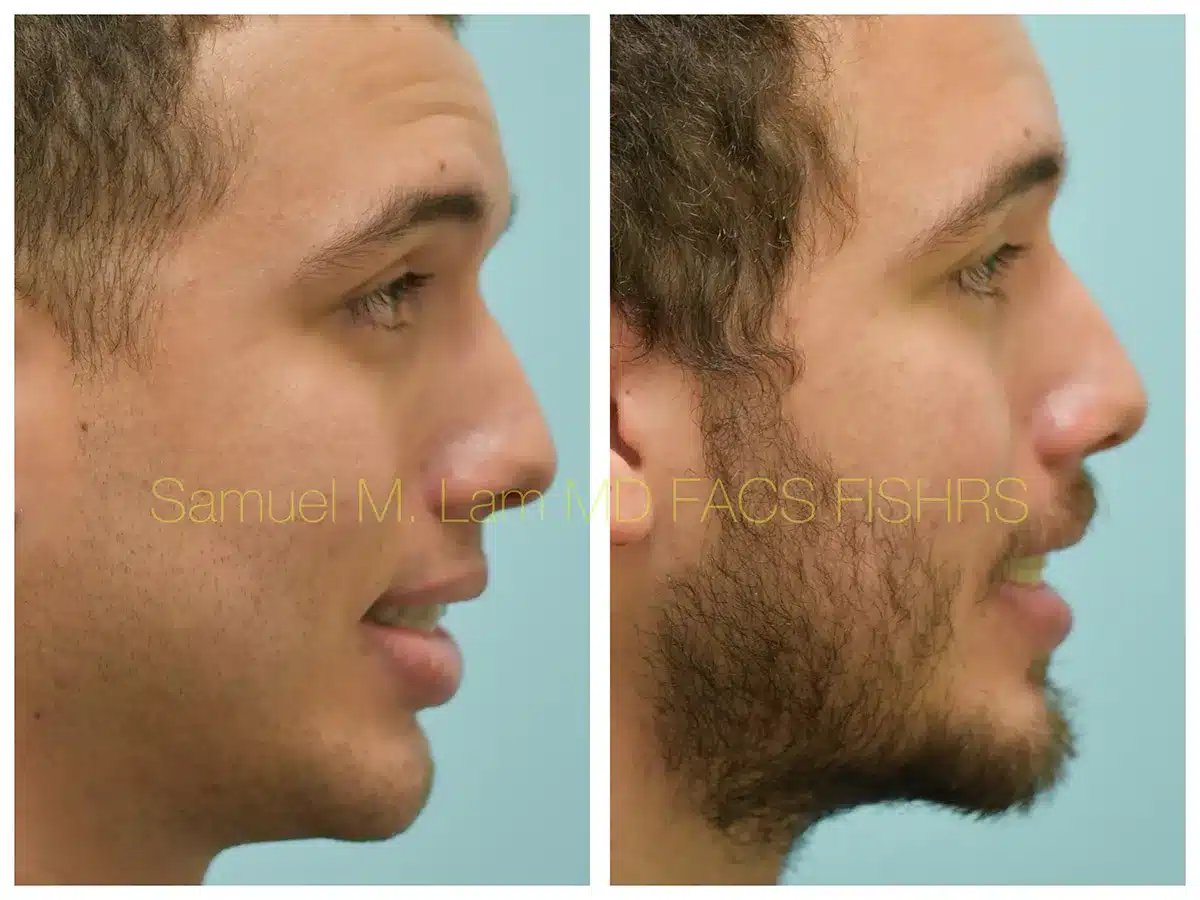 Lip Reduction Before and After Photo by Dr. Lam in Plano TX