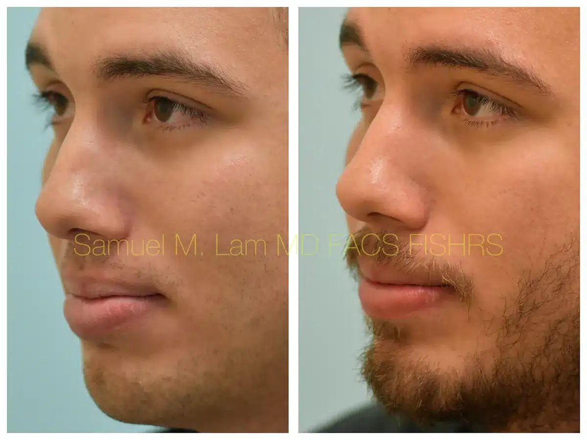 Lip Reduction Before and After Photo by Dr. Lam in Plano TX