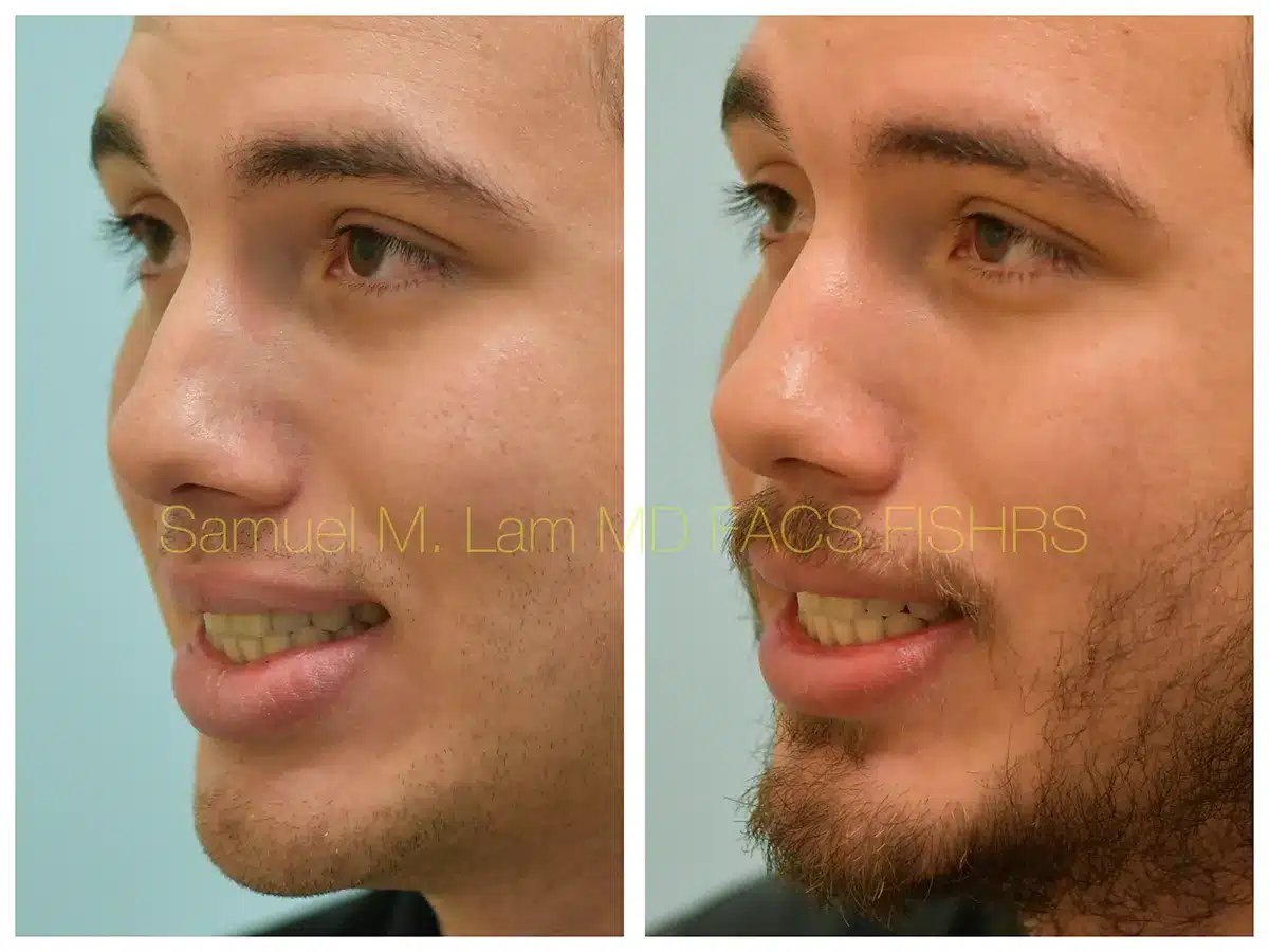 Lip Reduction Before and After Photo by Dr. Lam in Plano TX