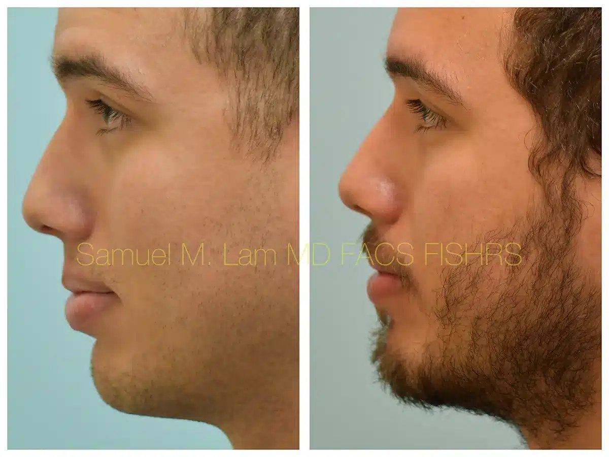 Lip Reduction Before and After Photo by Dr. Lam in Plano TX