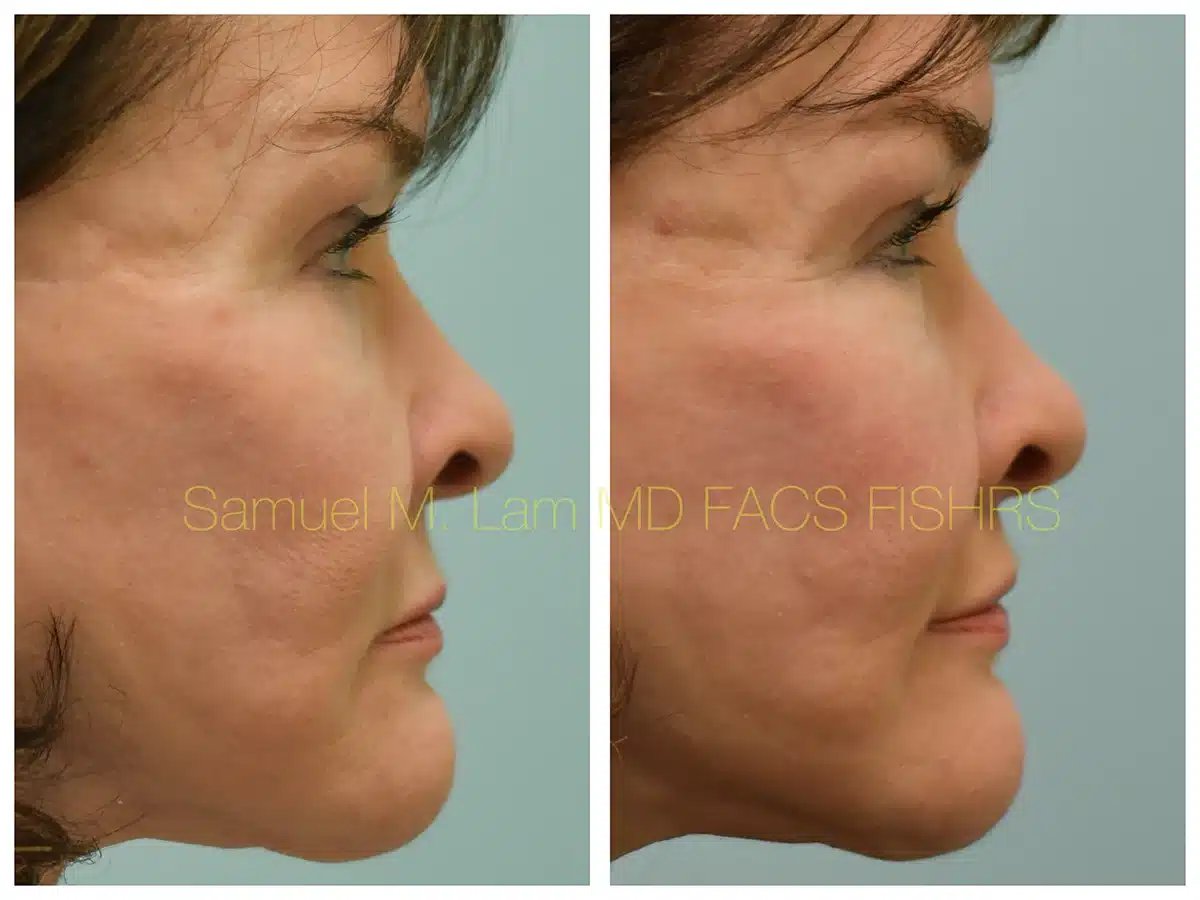 Lip lift Before and After Photo by Dr. Lam in Plano TX