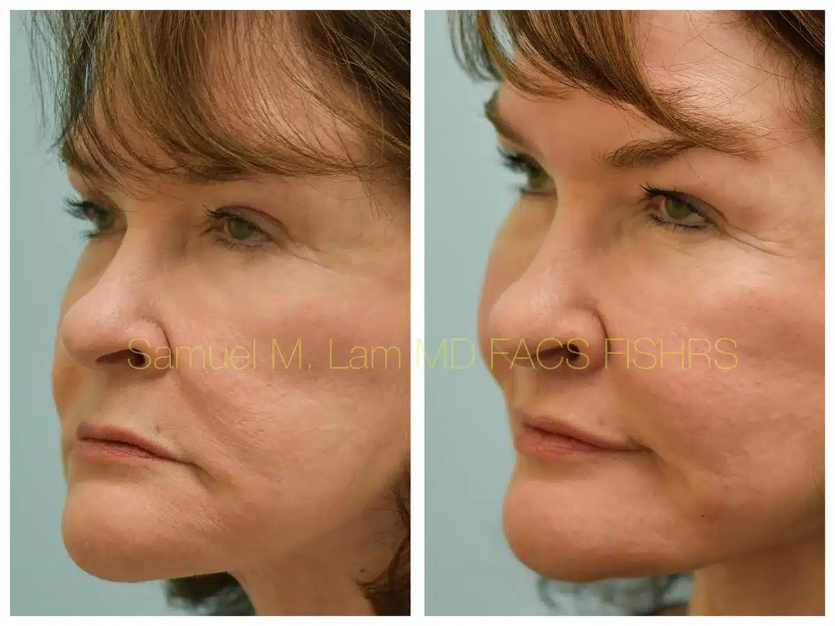 Lip lift Before and After Photo by Dr. Lam in Plano TX