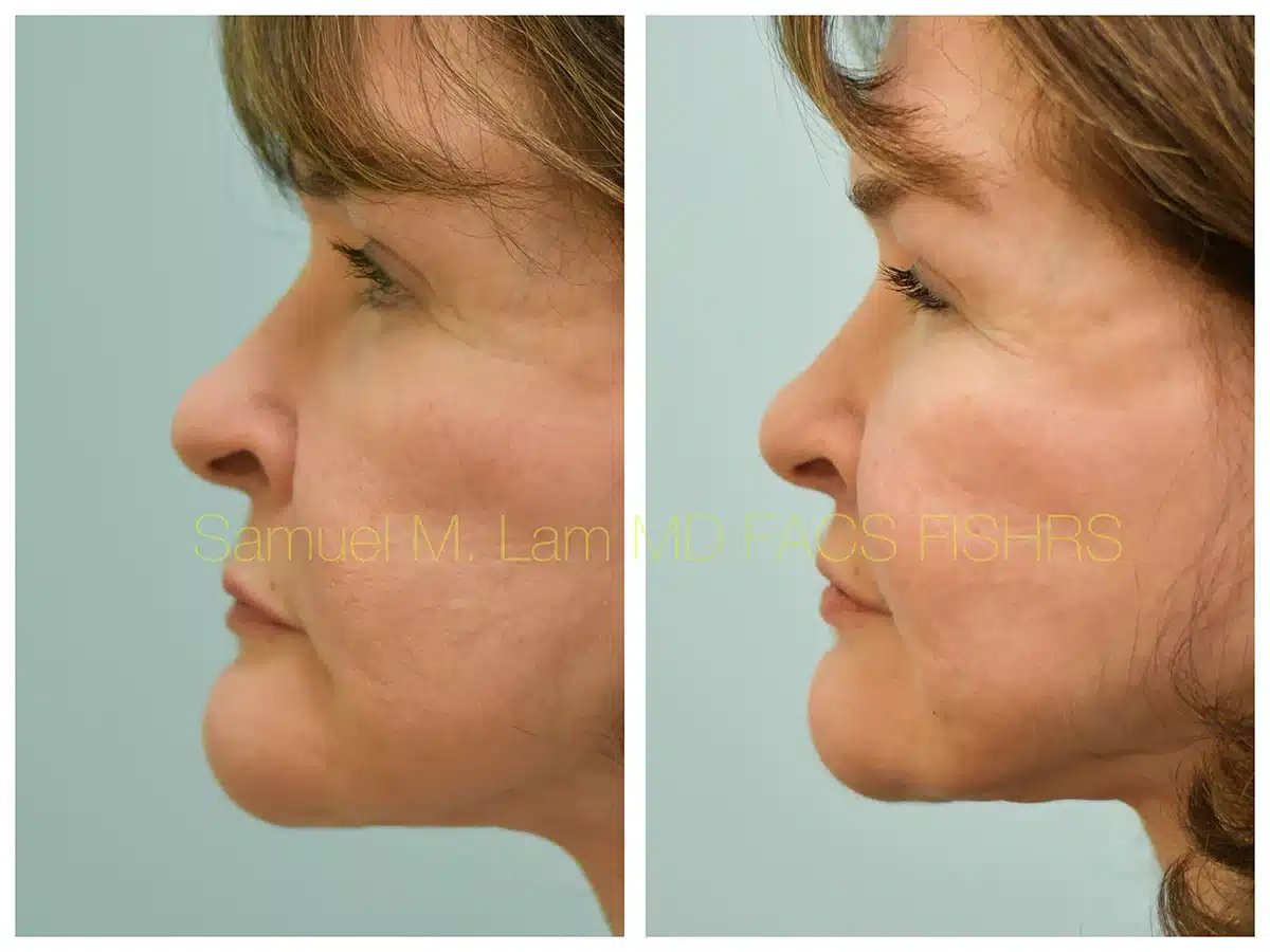 Lip lift Before and After Photo by Dr. Lam in Plano TX