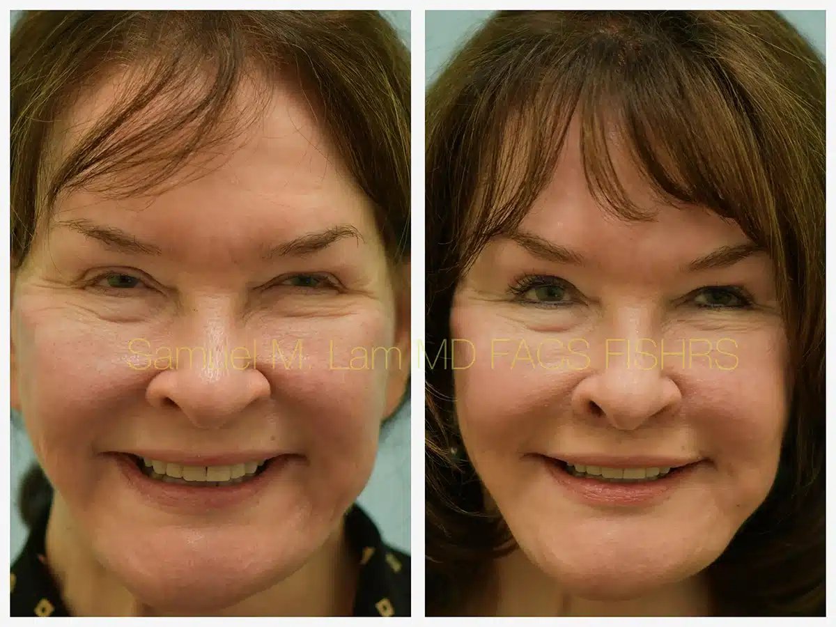 Lip lift Before and After Photo by Dr. Lam in Plano TX