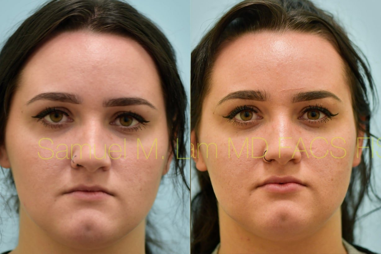 lip enhancement lip enhancement